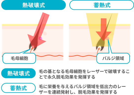 ショット式は毛の基となる毛母細胞をレーザーで破壊することで永久脱毛効果を発揮する。蓄熱式は毛に栄養を与えるバルジ領域を低出力のレーザーを連続発射し、脱毛効果を発揮する